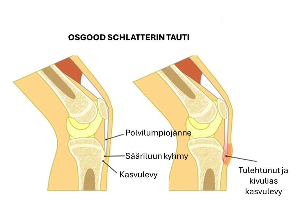 Polven rasitusvamma Osgood Schlatter